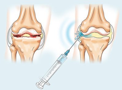 Ін'єкція в колінний суглоб